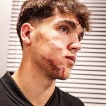 Trung vệ Barca phải khâu 10 mũi trên mặt