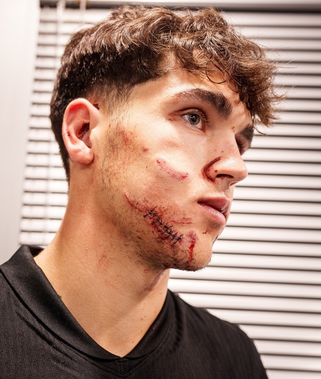 Trung vệ Barca phải khâu 10 mũi trên mặt